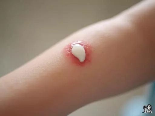 Molluscum percé : ce qui se passe et comment soigner la zone